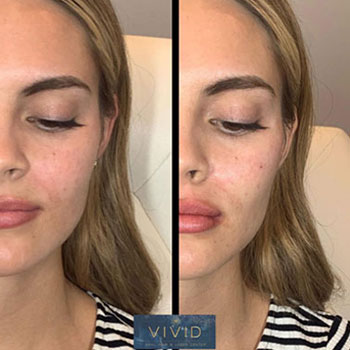 Before and after image of lip filler