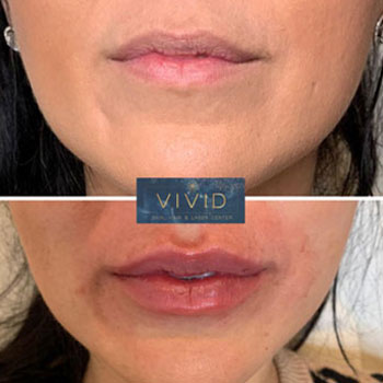 Vivid Lip Filler - Medspaaz