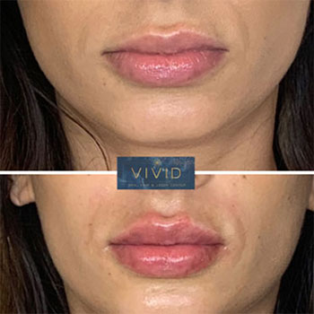 Vivid Lip Filler - Medspaaz