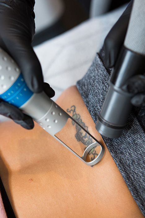 Tattoo Removal Skin Care - Medspaaz