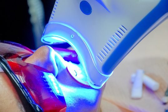teeth whitening process