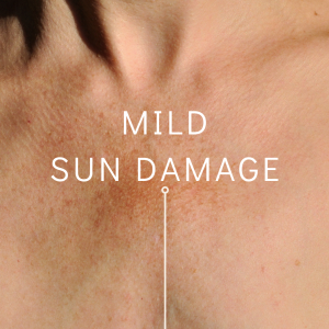 mild sun damage