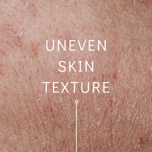 uneven skin texture