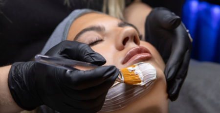 Acne Rescue Facial Treatment