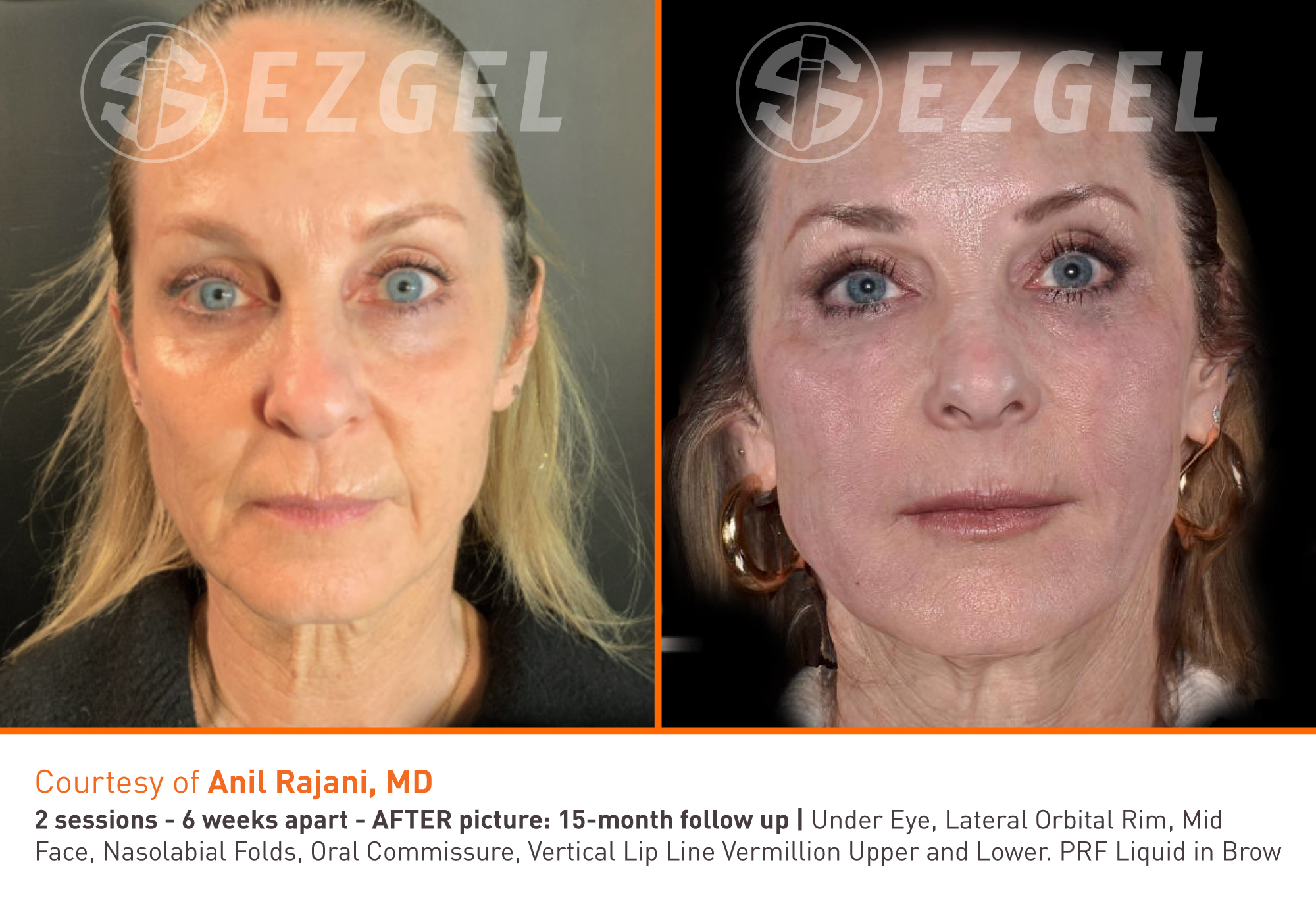 ezgel-1 ezgel-1