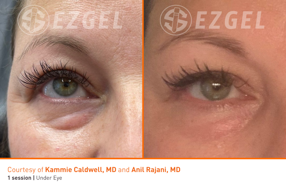 ezgel-10