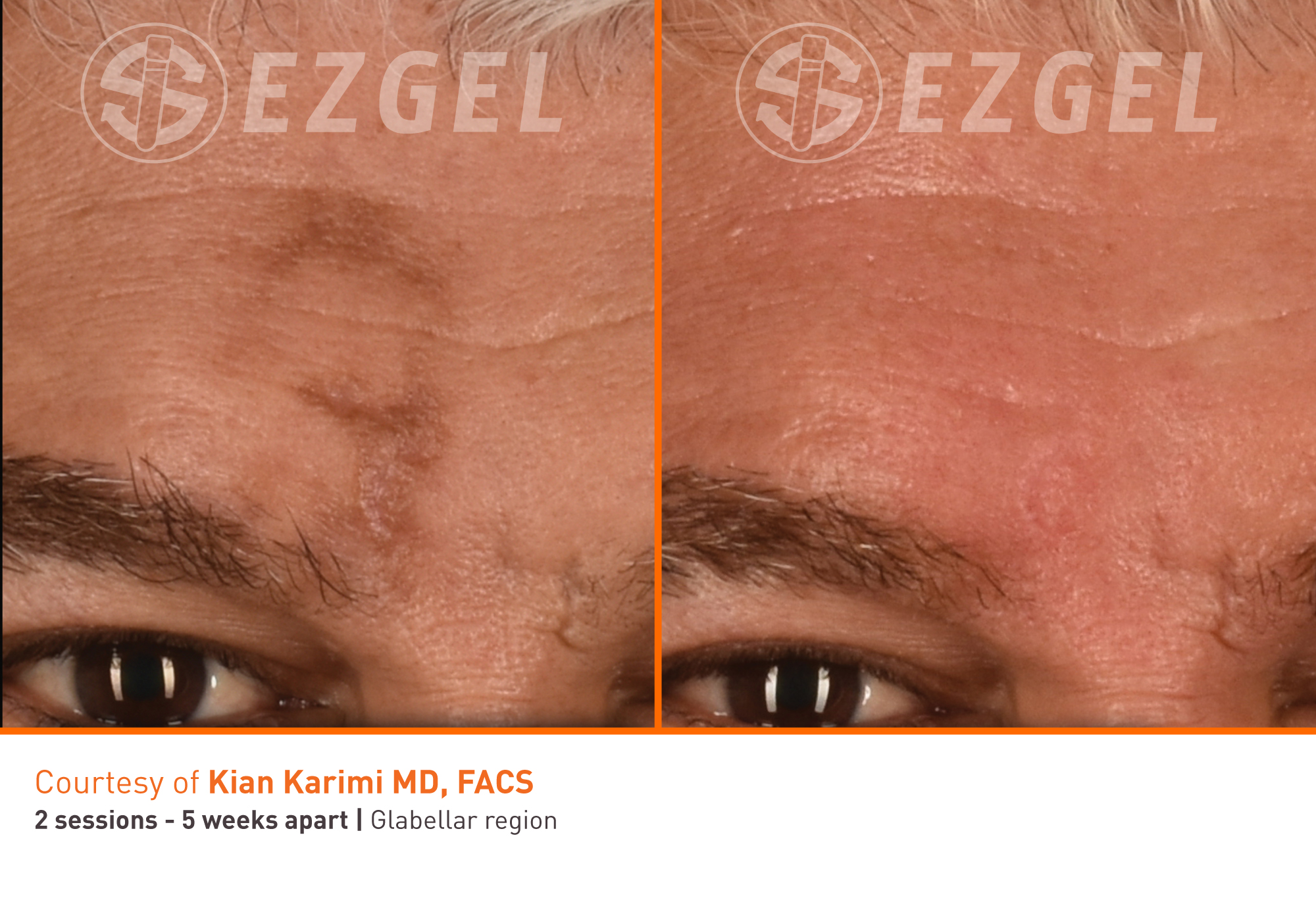 ezgel-11 ezgel-11