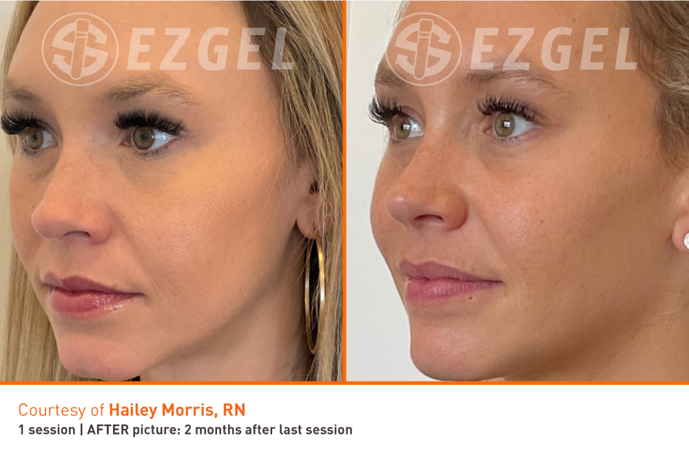 ezgel-15 ezgel-15