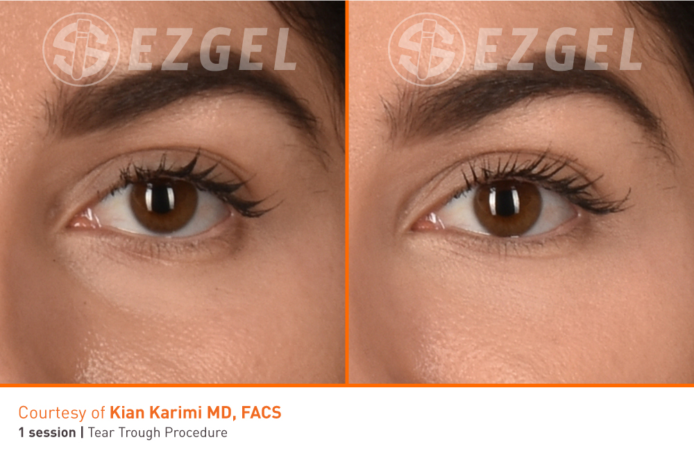 ezgel-4 ezgel-4