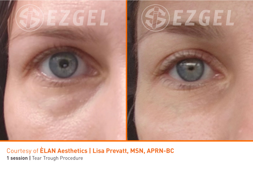 ezgel-7