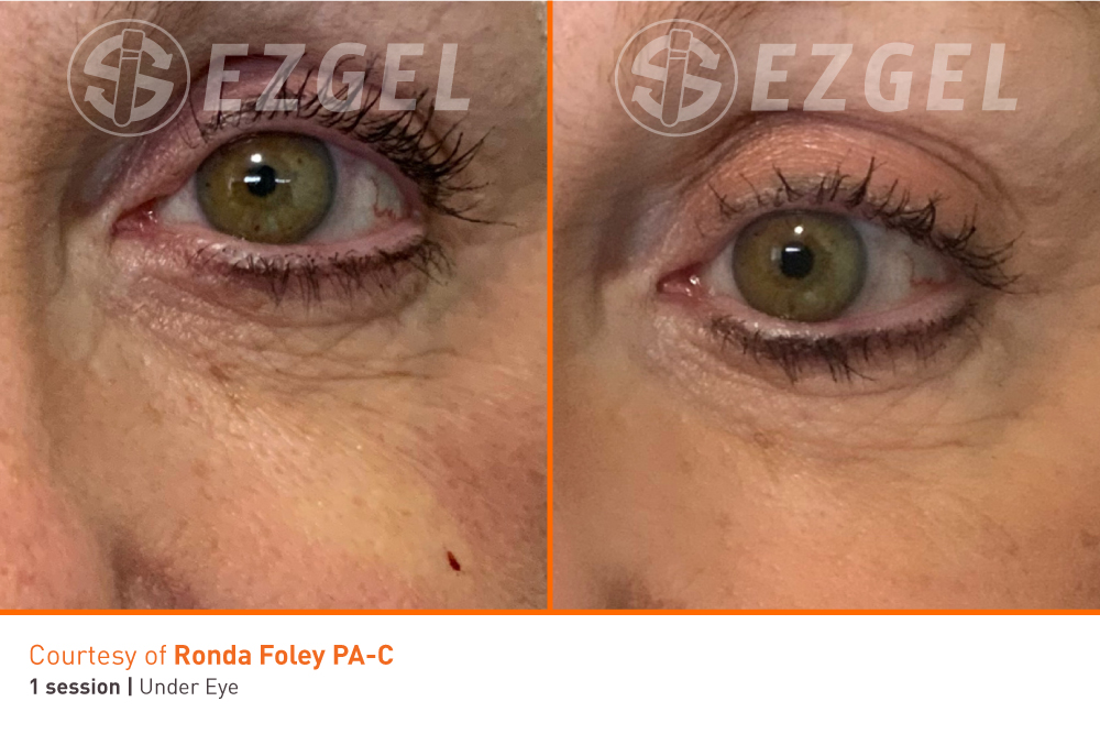 ezgel-8