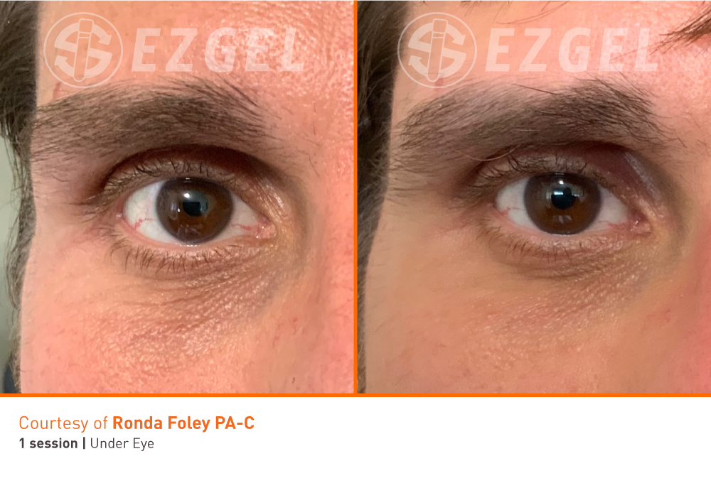ezgel-9