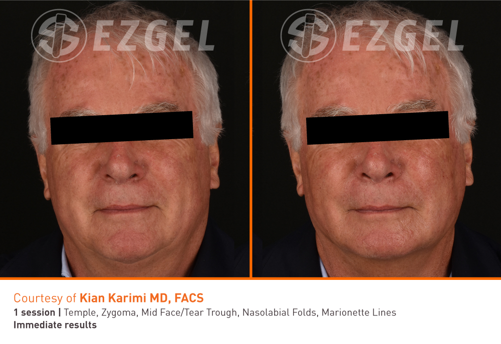 ezgel-luc