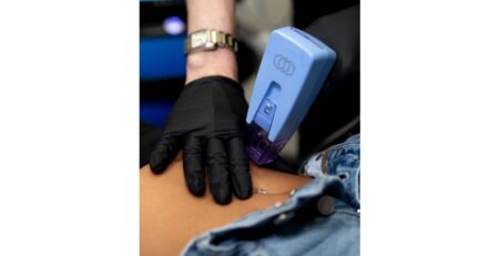 Laser Hair Removal