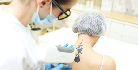 Laser Tattoo Removal