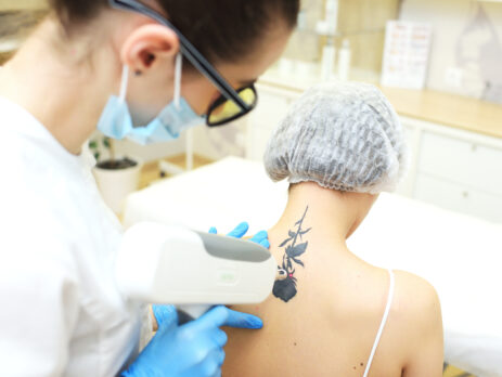 Laser Tattoo Removal