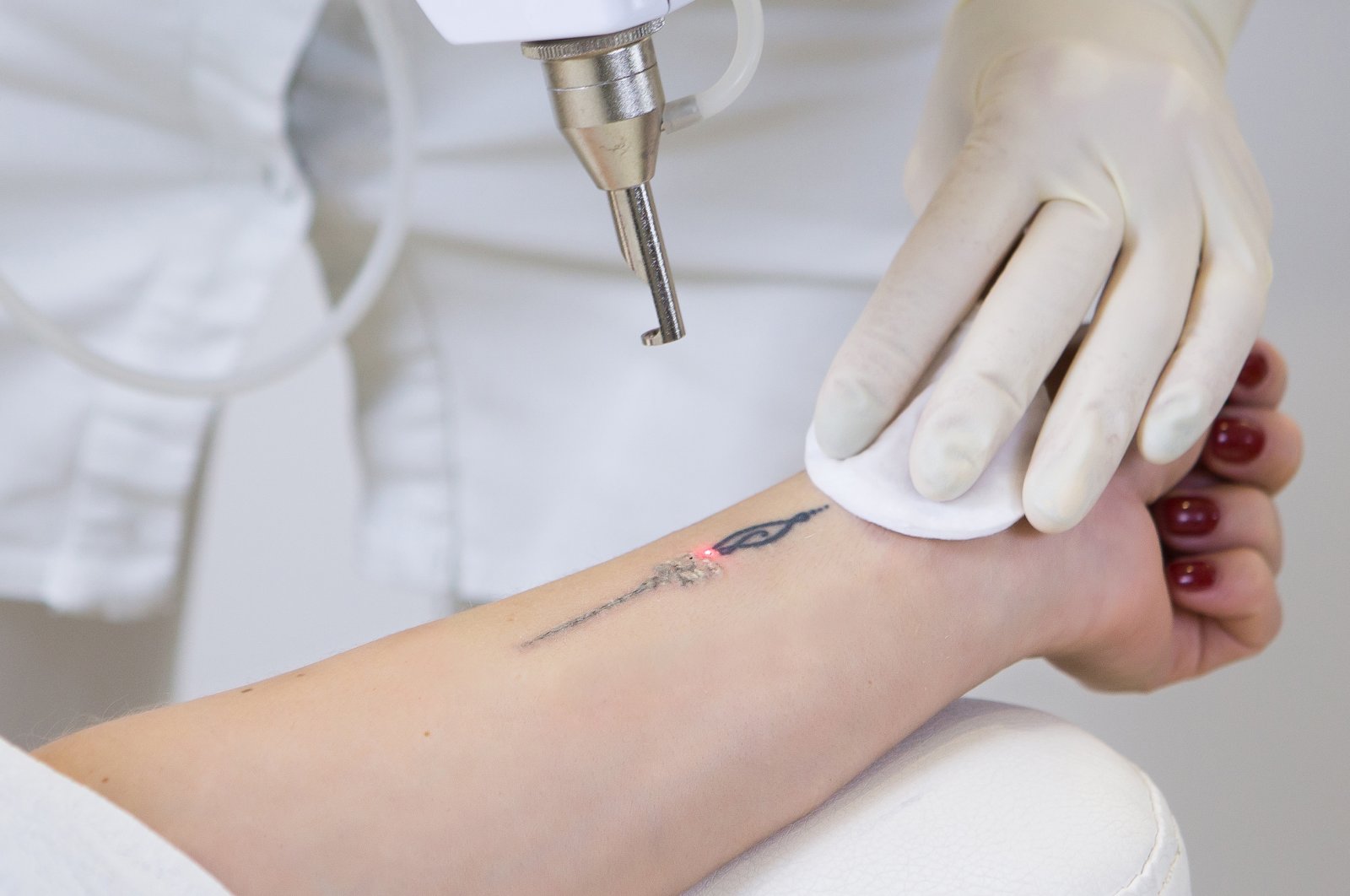 Tattoo Removal Journey