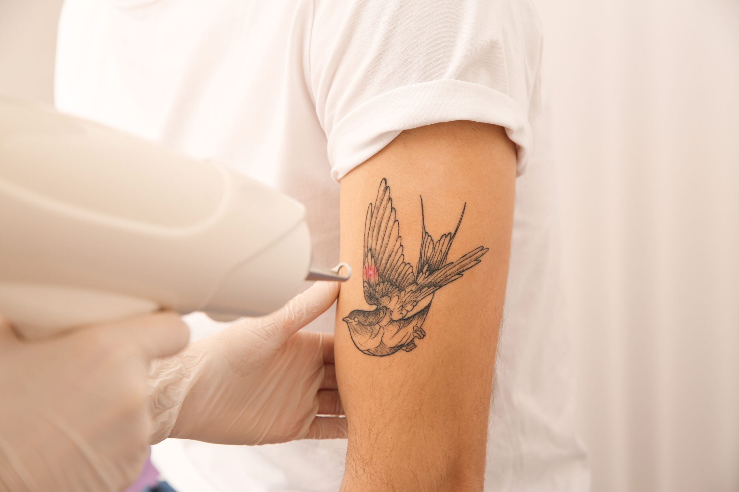 Tattoo Removal Success